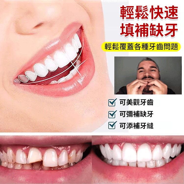 吸附性微笑牙套